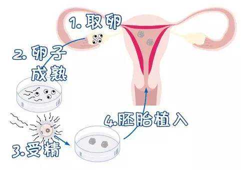 广州单身女人找助孕，广州供卵试管费用多少？广州供卵助孕机构靠谱吗？